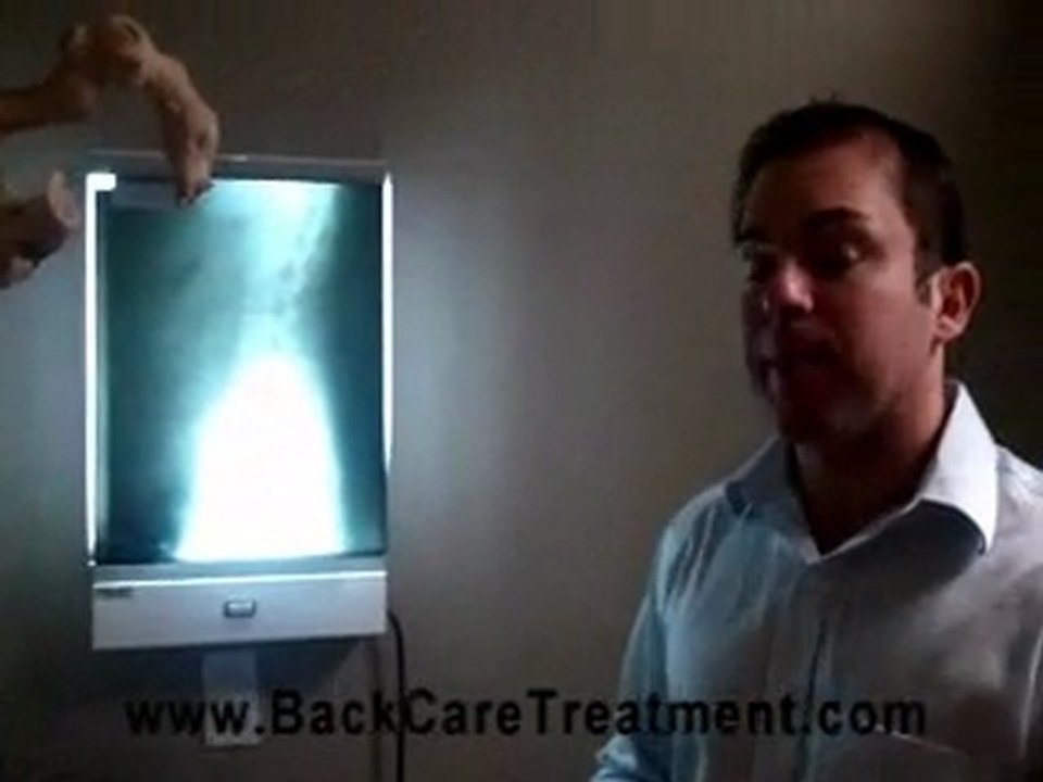 Disc damage on x-rays