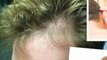 tratamientos naturales para el cabello - tratamientos para el crecimiento del cabello - calvicie cura