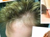 tratamientos naturales para el cabello - tratamientos para el crecimiento del cabello - calvicie cura