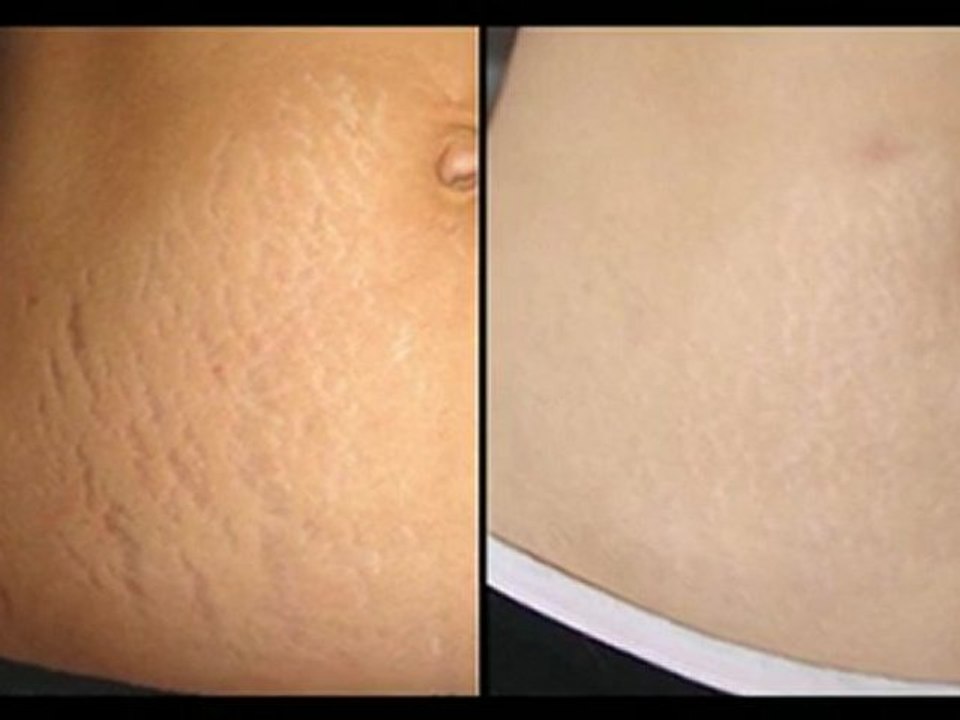 Como Eliminar Las Estrias