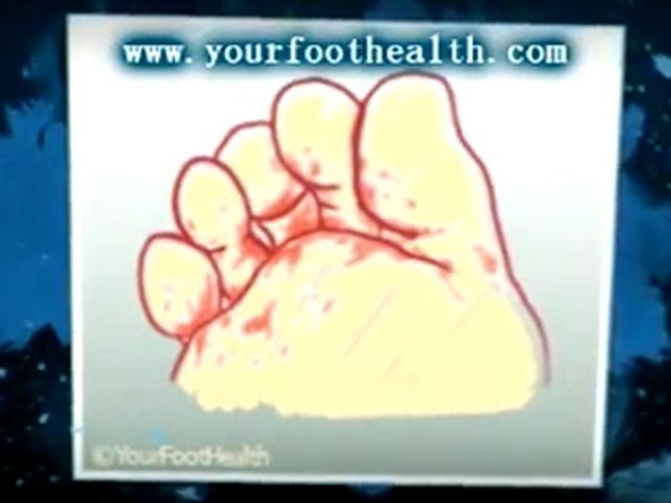 Foot Problems