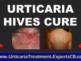 Home remedies for hives - solar urticaria acute urticaria