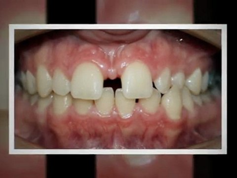 Invisalign Greeley Sept2011