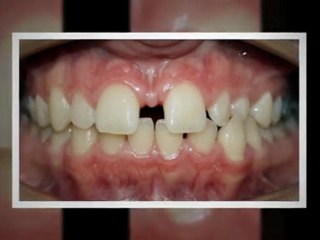 Invisalign Greeley Sept2011