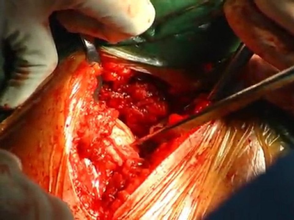 Shoulder resurfacing procedure - part 2.Dr.Venkatachalam