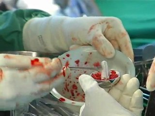 Shoulder Resurfacing part 3- Dr.Venkatachalam