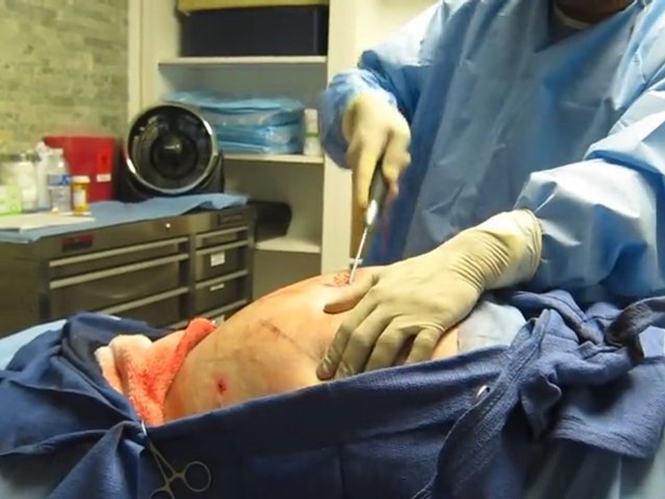 Liposuction-Laser Liposuction-SmartLipo Laser Liposuciton-Love Handles Liposuction