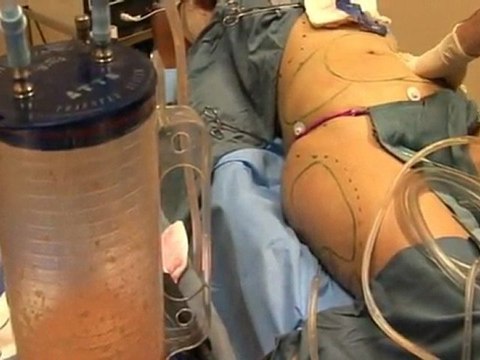 Vaser Liposuction - Ultrasound Liposuction with DrTreoll.Com