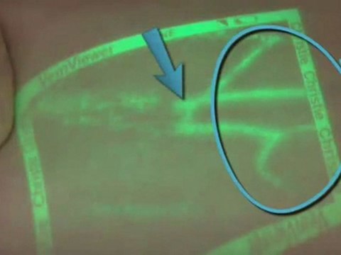 VeinViewer : appareil médical pour voir les veines