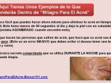 tratamientos caseros para el acne - acne en la espalda - como eliminar las espinillas