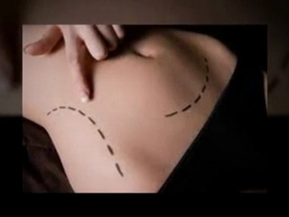 What is SmartLipo