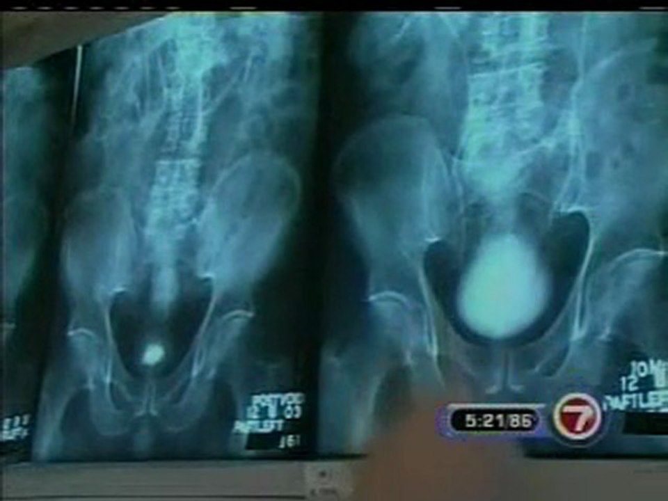 PSA and Prostate Cancer in a Young Patient