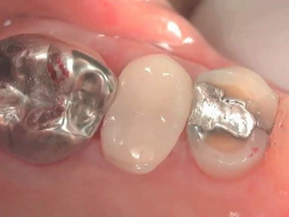 Why Mercury Will Break Your Teeth - Holistic Dentist
