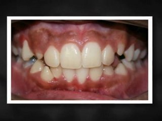 Invisalign Greeley Nov2011