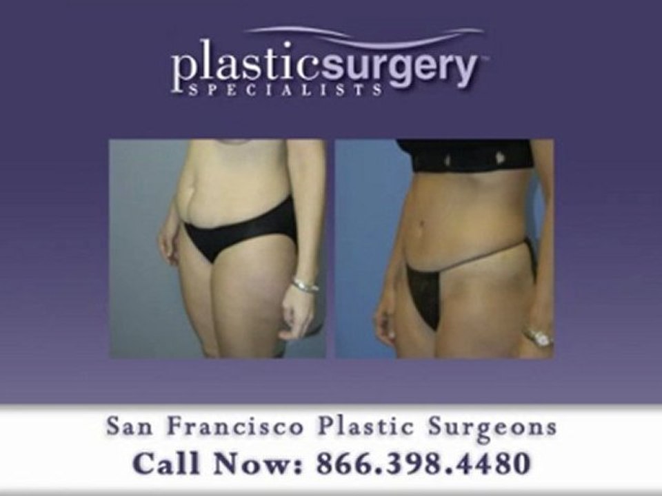 Tummy Tuck Marin County