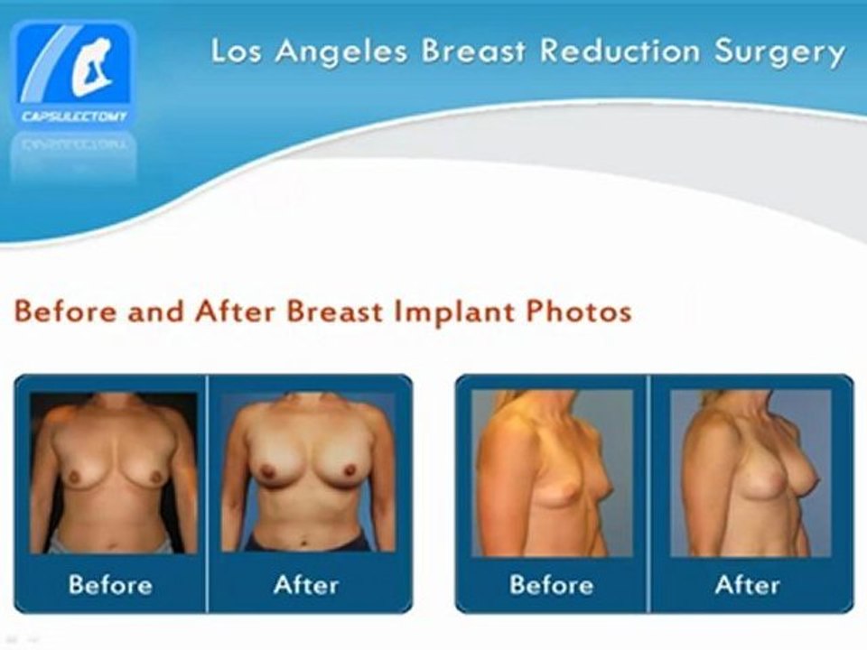 Breast Implant & Reduction Surgery - Breast Reduction Surgery Los Angeles