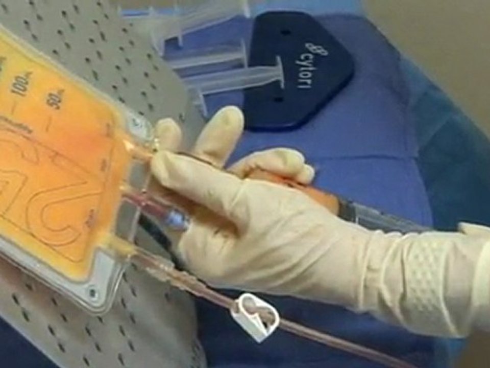 Procedure of Fat Grafting