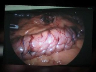 Gastric Plication Quick Explanation