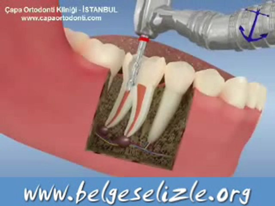 Kanal Tedavisi Nasıl Yapılır ? www.belgeselizle.org