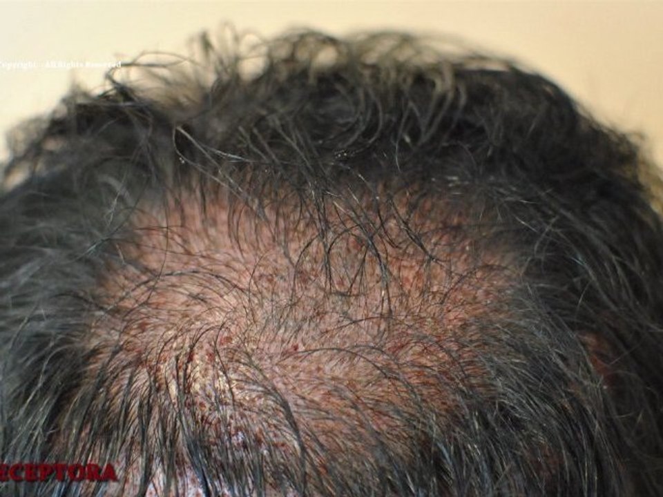 FUE_3331_Ufs_By_MEDIKEMOS_HAIR_TRANSPLANTATION_ES