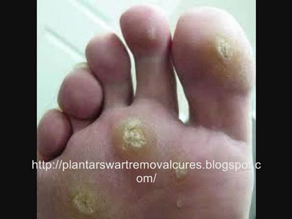 Plantars Wart Removal and Cures