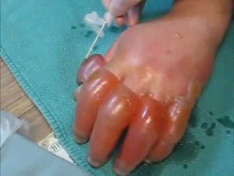 Grosses engelures aux doigts de la main