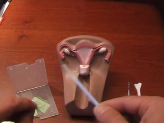 Le frottis du col de l'utérus