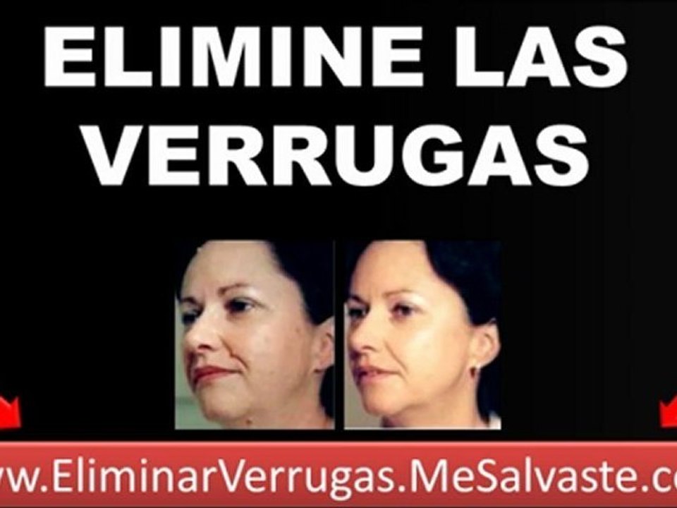 Como Eliminar Verrugas - Tipos De Verrugas