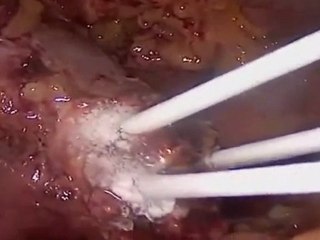 CRIOTERAPIA PER CURARE I TUMORI