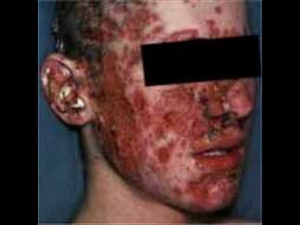 Como eliminar el acne - Eliminar acne rapido