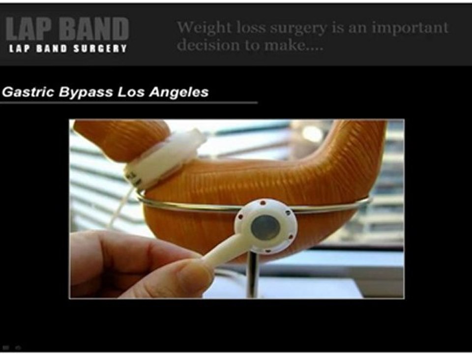 Lap Band & Body Lift Surgery Los Angeles  - Gastric Bypass Surgery