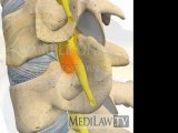 Cervical Spine Pathology Intervertebral Disc Sequestration orthopedic artwork