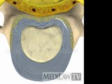 Cervical Spine Pathology Intervertebral Disc Annular Circumferential Tear medical legal exhibit illustrations