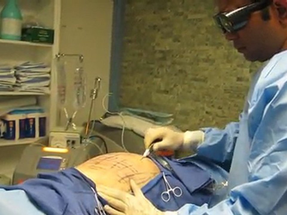 SmartLipo Laser Liposuction- Los Angeles County-Orange County-Riverside County-San Bernardino County-Inland Empire-Anaheim-Fullerton-Beverly Hills-Pasadena-Burbank-Hollywood-Cerritos-Long Beach-Irvine-Costa Mesa-Orange-Brea-Whittier-Pomona-Chino-Fontana