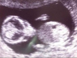 Un couple demande une échographie et découvre.. Un alien !