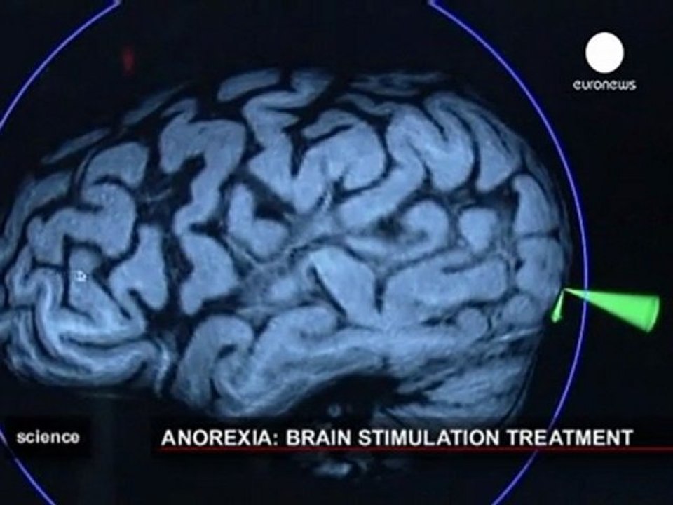 Une stimulation magnétique du cerveau contre l'anorexie