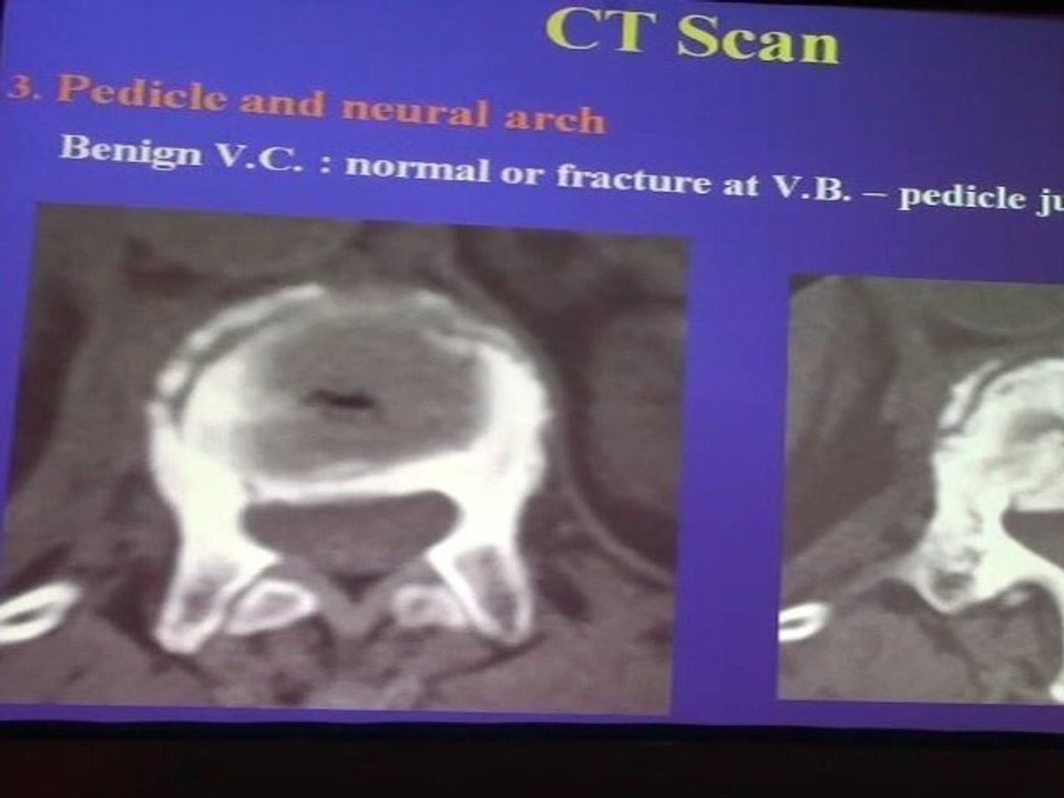 LAREDO Vertebral collapses