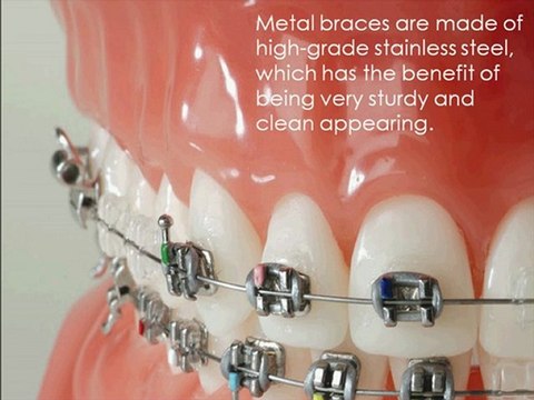 Metal Braces in Grand Rapids
