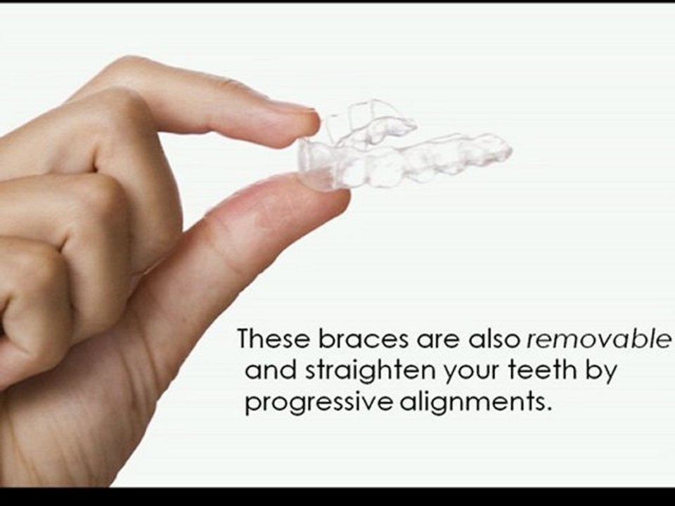 Invisible Braces Grand Rapids