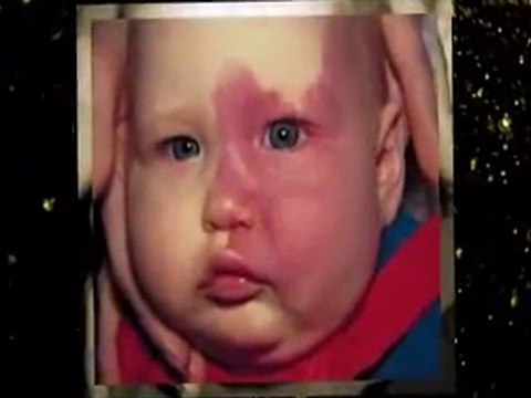 Port Wine Stain Birthmarks