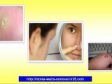 home remedies for wart removal - home mole removal - moles warts & skin tags removal