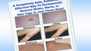 skin tag removal at home - skin tag removal - wart removal
