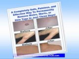 home wart removal - wart removal home remedies - mole removal