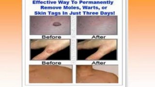 How to Remove Skin Moles - How To Remove A Mole - Home Wart Removal