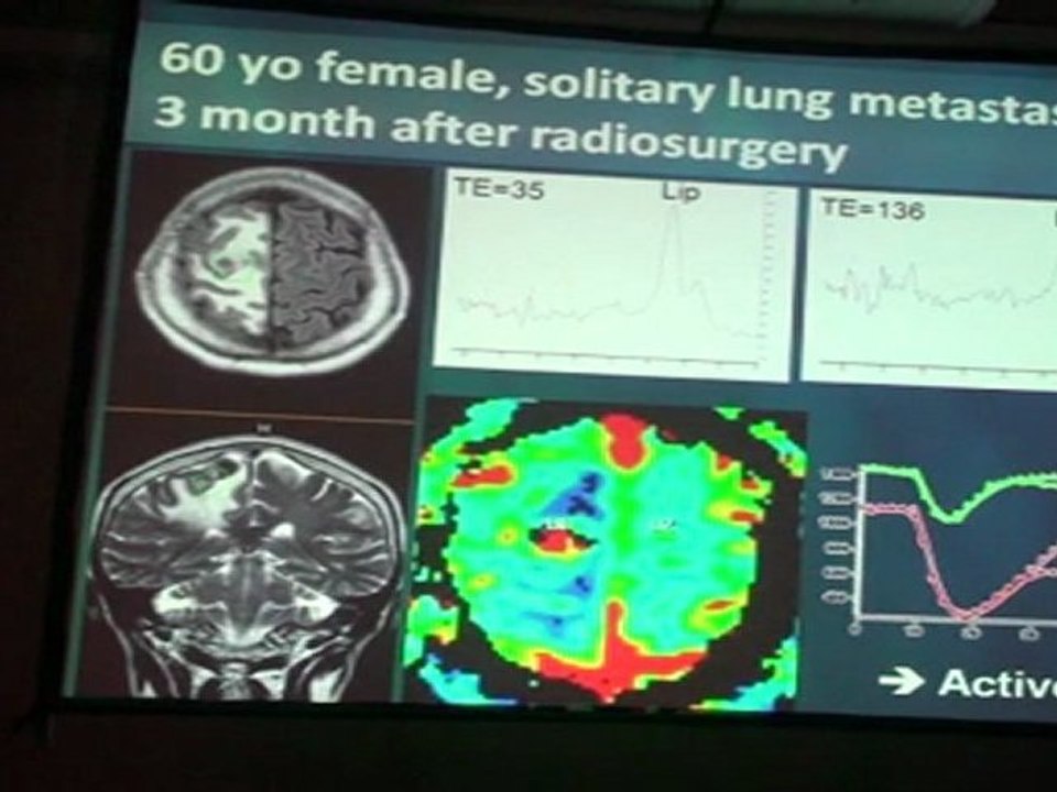 SAVATOVSKY BRAIN TUMORS CASES