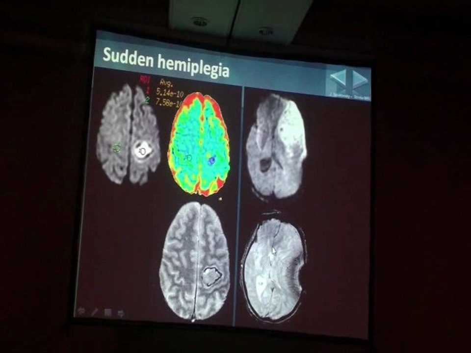 SAVATOVSKY STROKE MRI