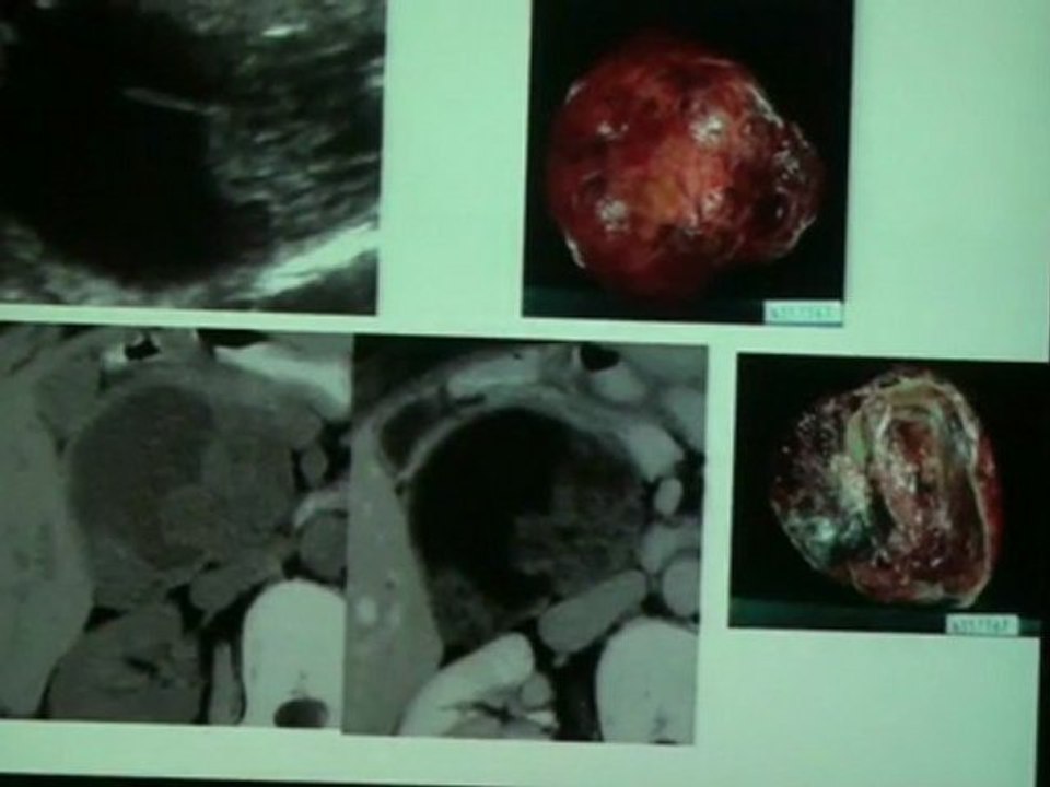 VULLIERME BILIARY CASES 2010