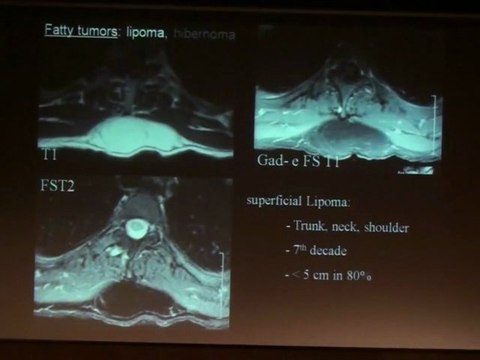 LAREDO Soft tissue tumors 2010