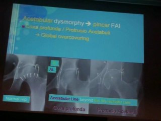 BELLAICHE FEMORO-ACETABULAR IMPINGEMENT