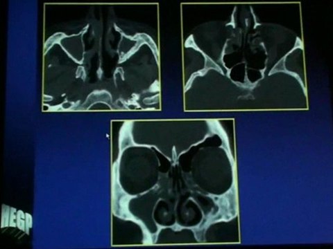 HALIMI Chronic Sinusitis - New Classification of Diseases